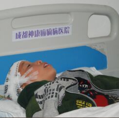 癫痫怎么治疗